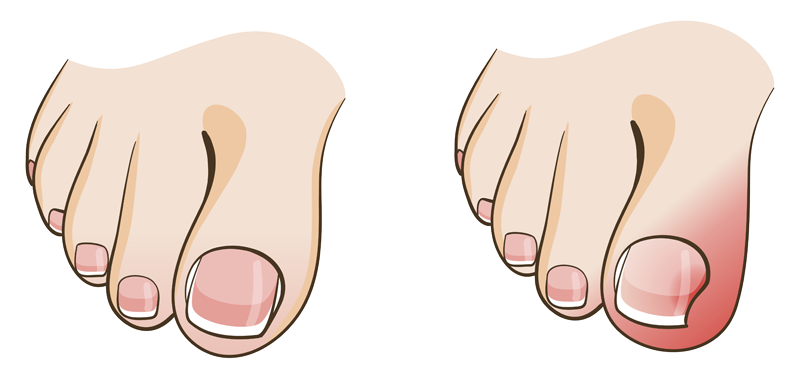 batık tırnak resim ikon