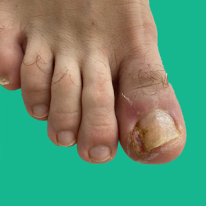 cerrahi öncesi batık tırnak