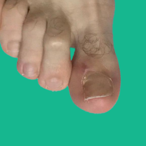 cerrahi sonrası batık tırnak