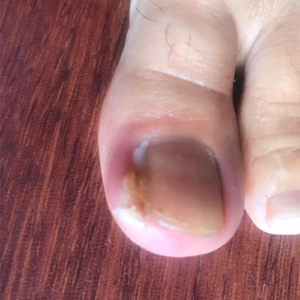 patmış tırnak fotoğrafı