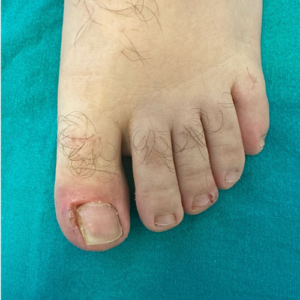 tedavi edilmiş tırnak 1