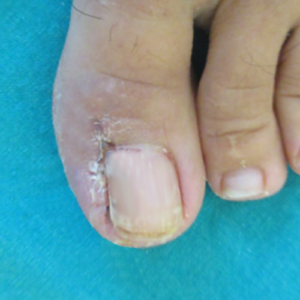 tedavi edilmiş tırnak